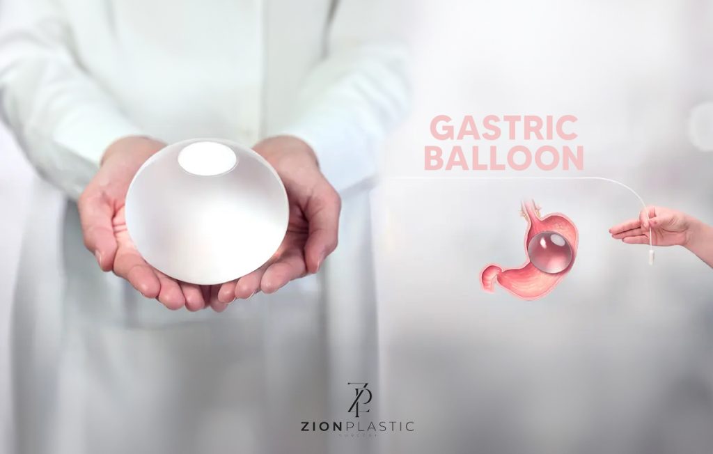 gastric balloon