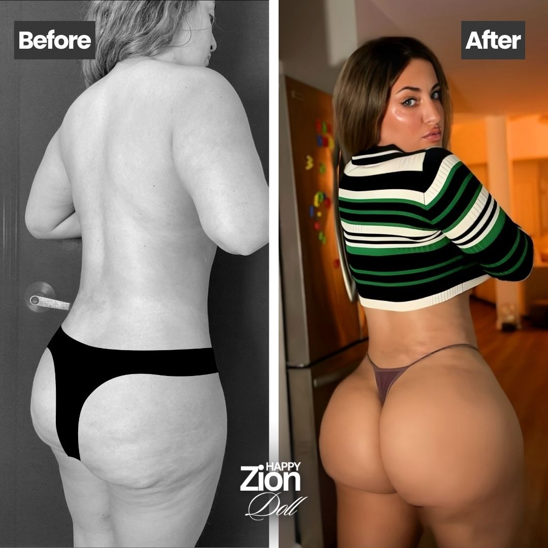 Brazilian Butt Lift before and after — Zion Plastic Surgery