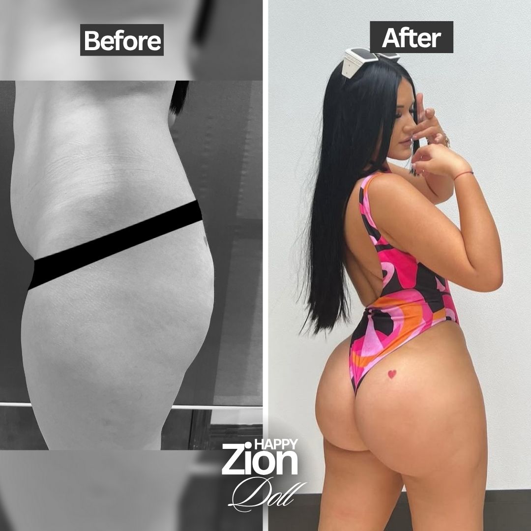 Brazilian Butt Lift transformation — Zion Miami
