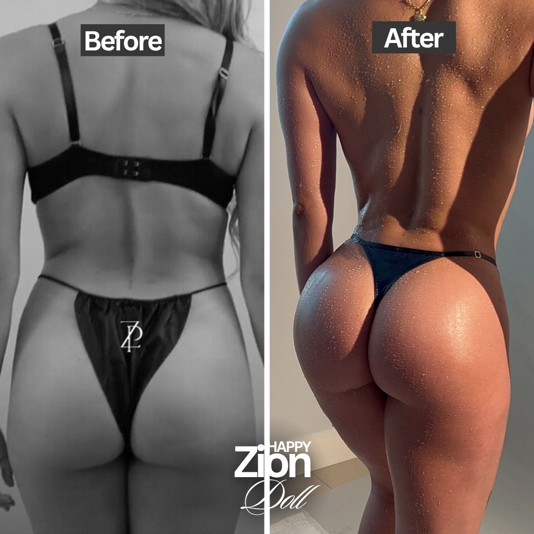 BBL patient before and after — Zion Plastic Surgery