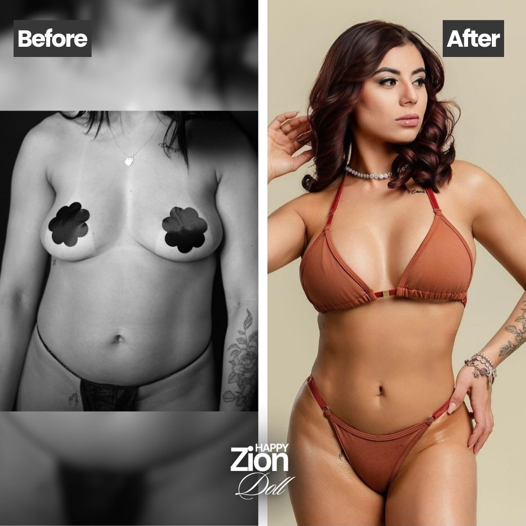 Liposuction before and after — Zion Plastic Surgery Miami