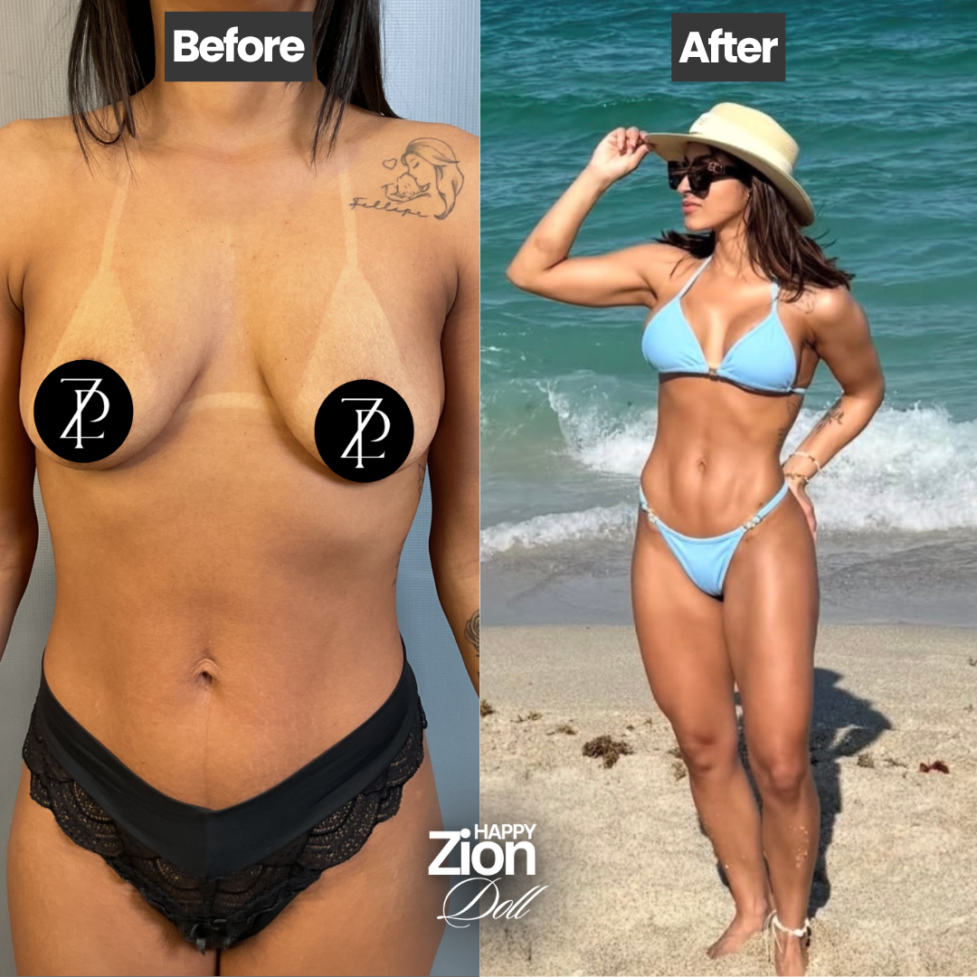 Lipo 360 before and after — Zion Plastic Surgery