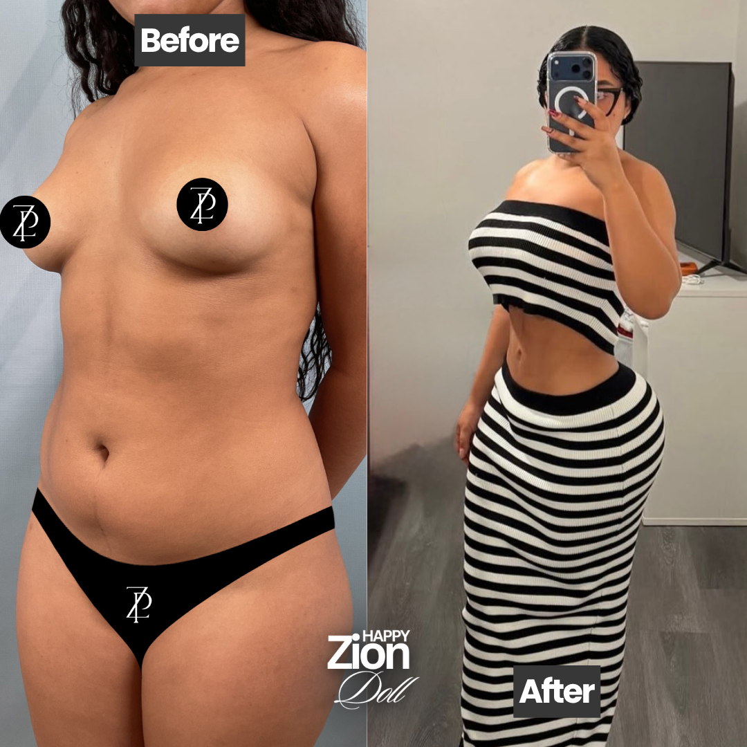 Liposuction result Miami — Zion Plastic Surgery