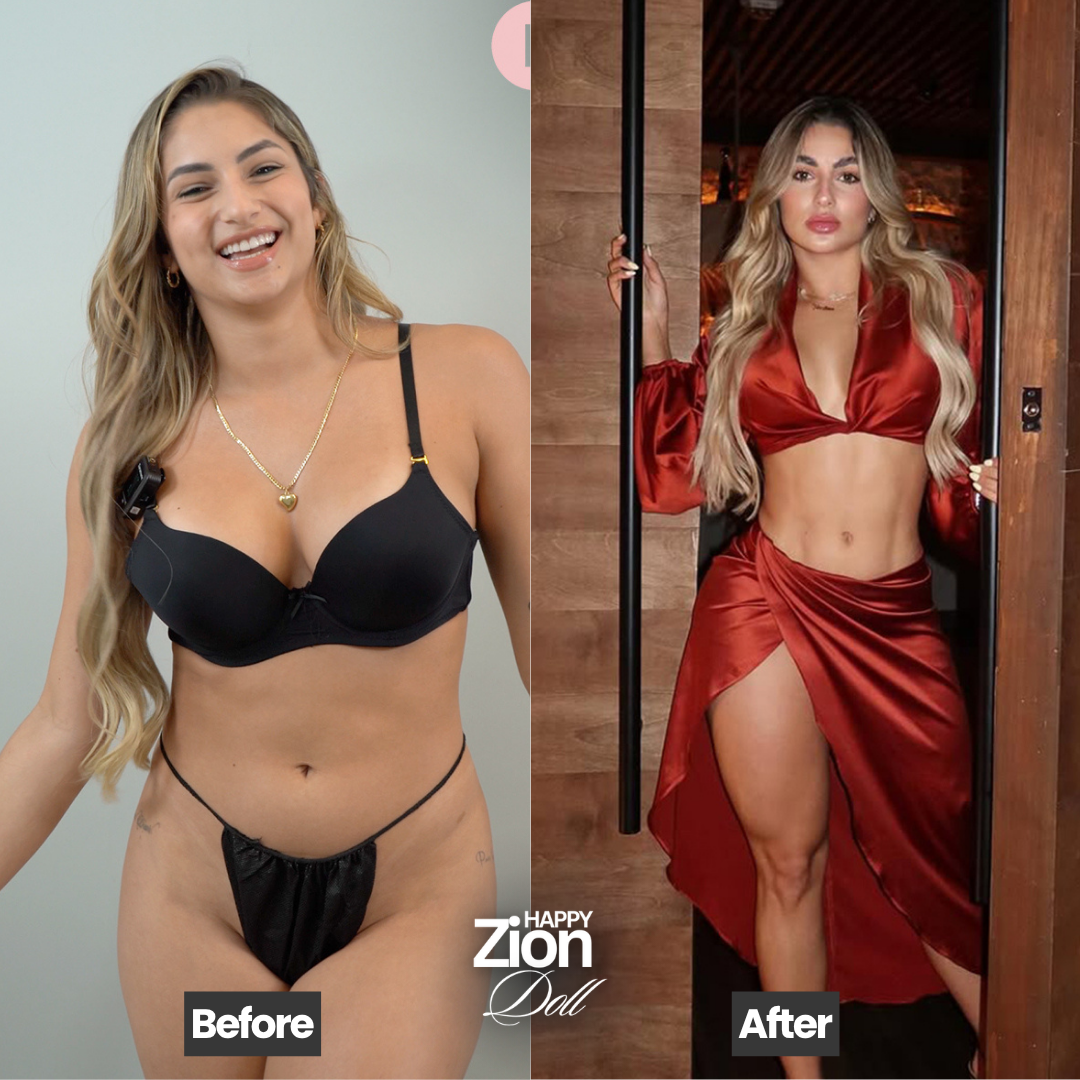 Body liposuction before and after — Zion Miami