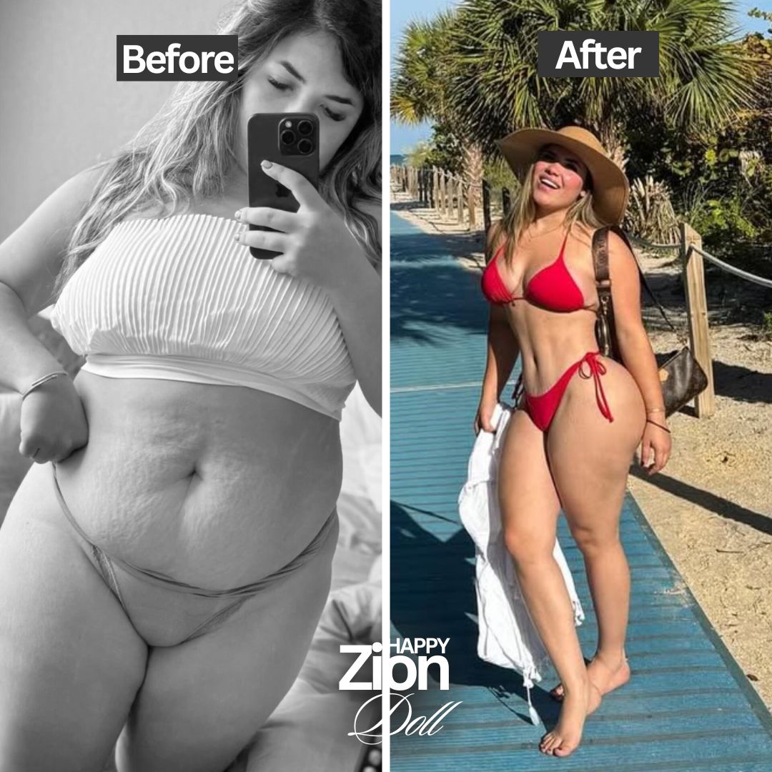 Tummy tuck before and after — Zion Plastic Surgery Miami