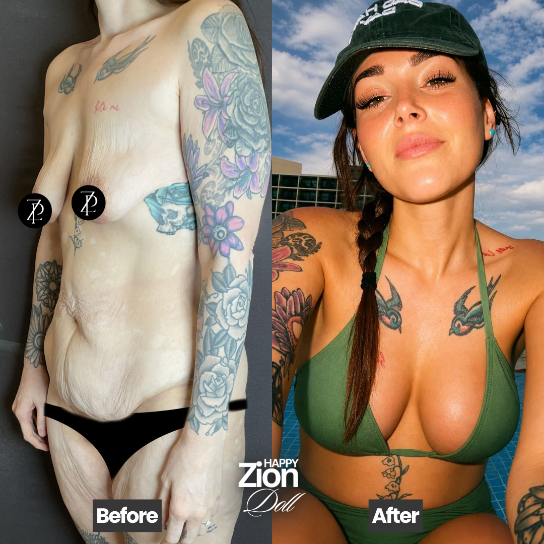 Abdominoplasty before and after — Zion Plastic Surgery