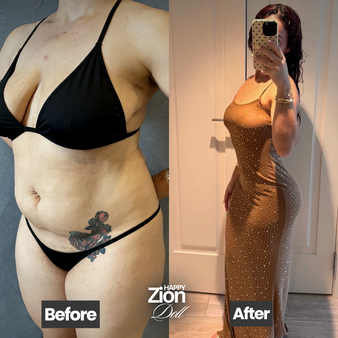 Tummy tuck transformation — Zion Miami