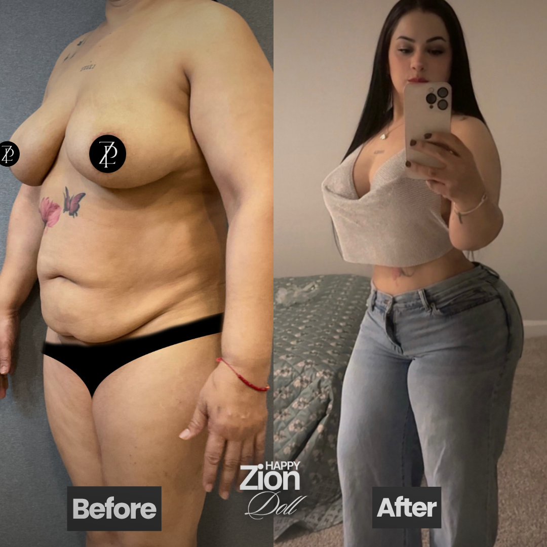 Tummy tuck result Miami — Zion Plastic Surgery