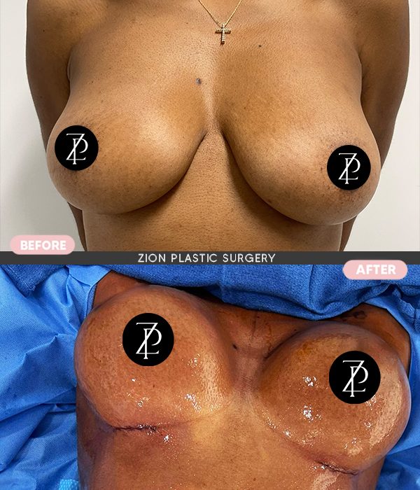 patient breast implants