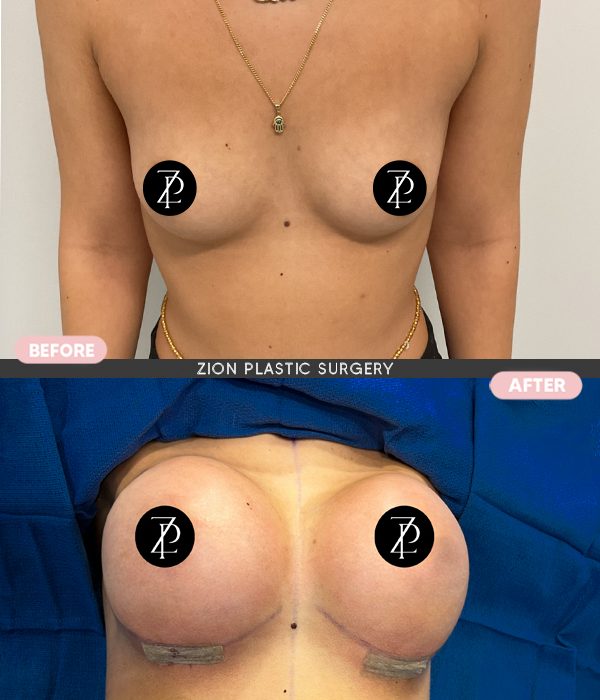 Breast augmentation