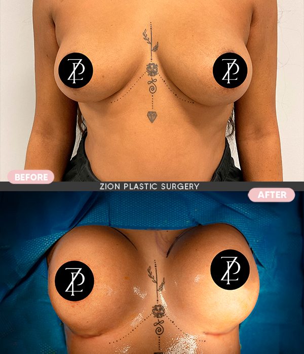 Breast augmentation