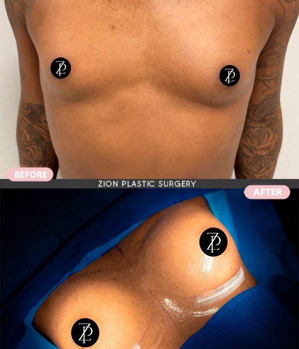 Breast augmentation