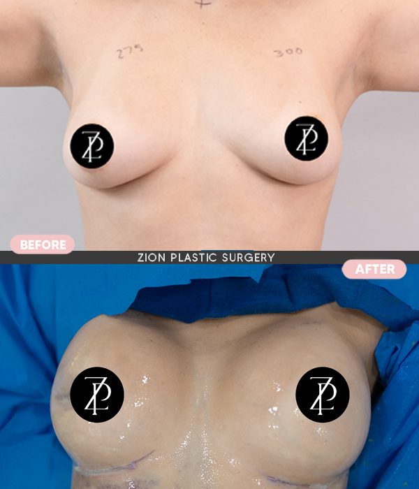 Breast augmentation