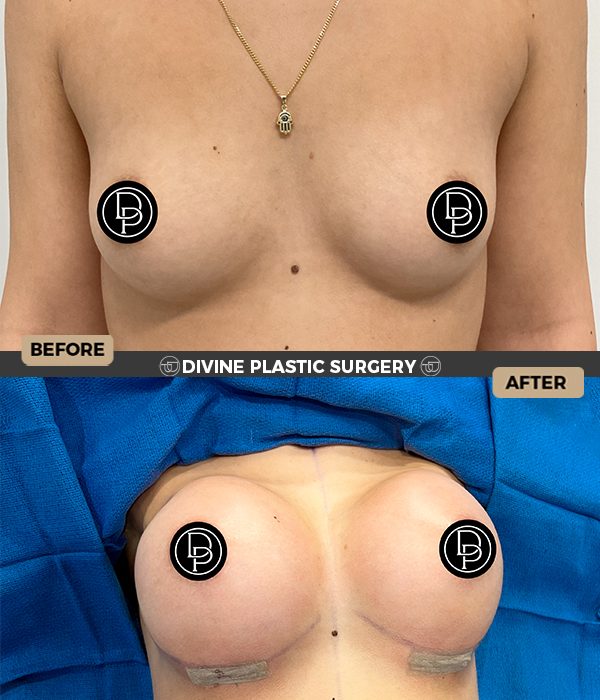 Breast augmentation