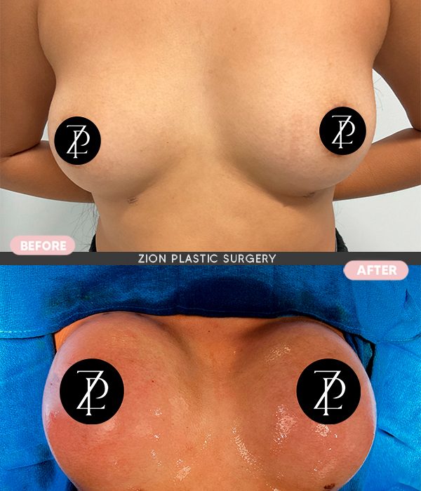 Breast augmentation