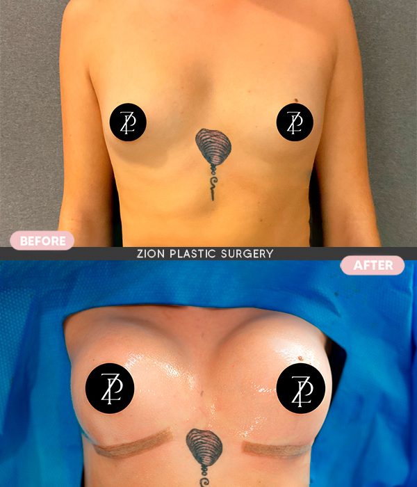 breast implants near me