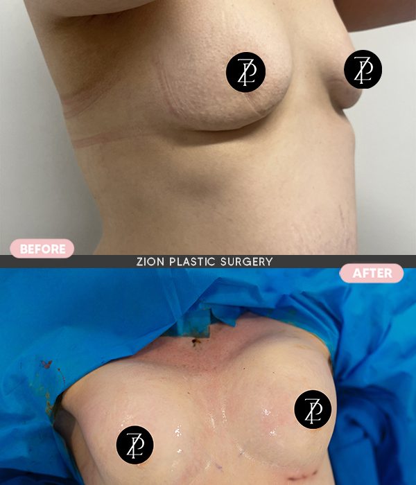 augmentation surgery