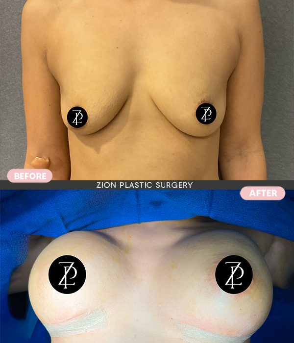 augmentation surgery