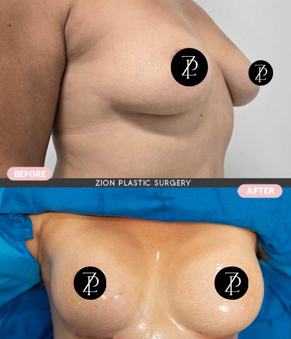 Breast augmentation