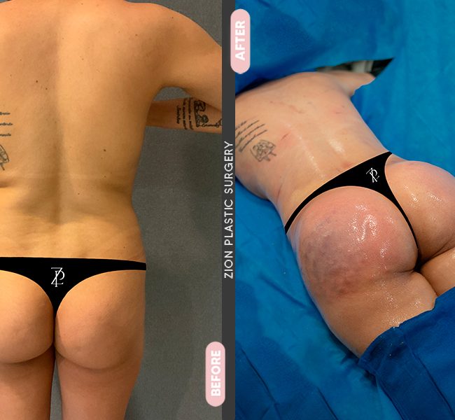 Gluteal Augmentation