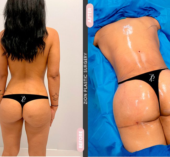 Gluteal Augmentation