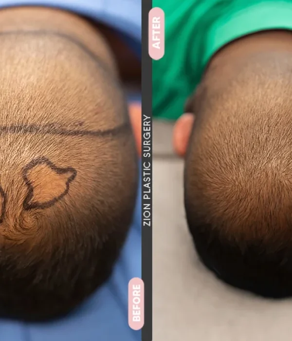 hair implant in Zion