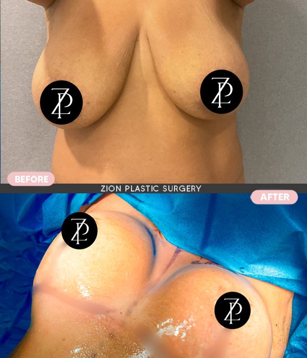 breast cosmetic