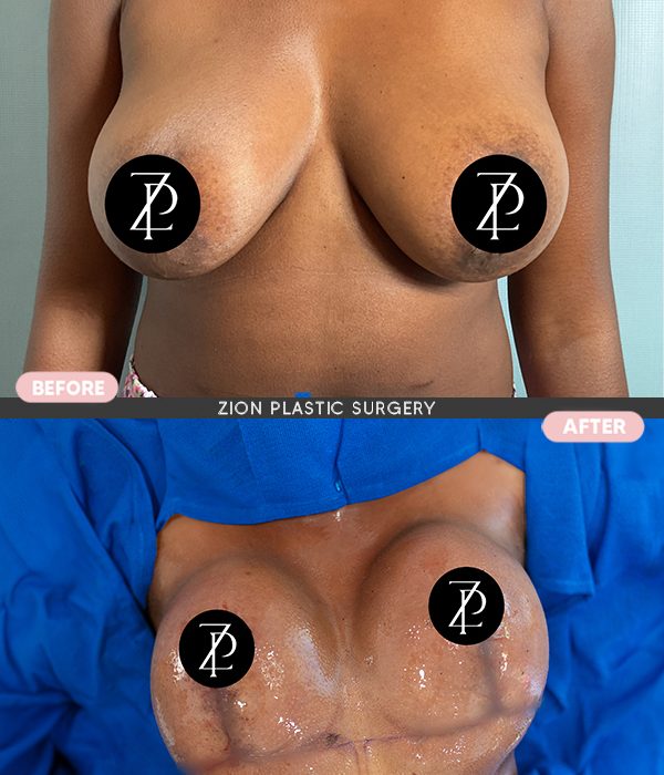 breast implants