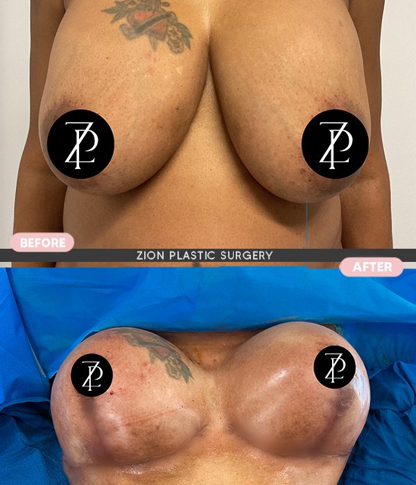 breast implants