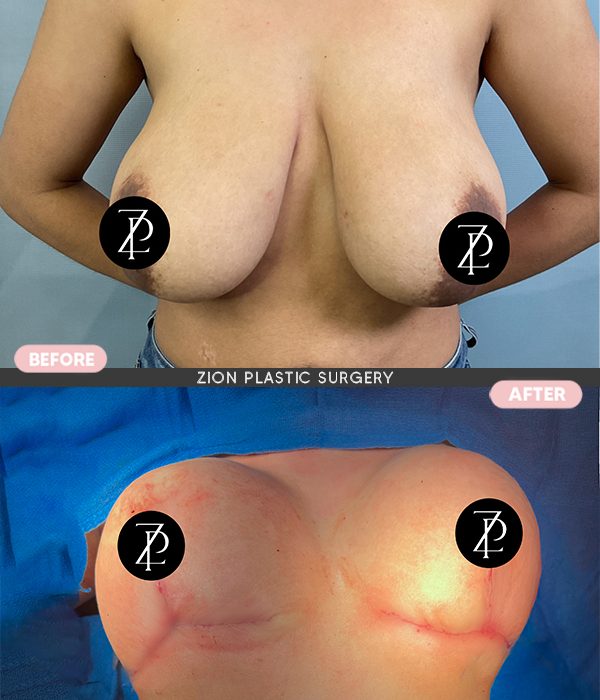 breast implants