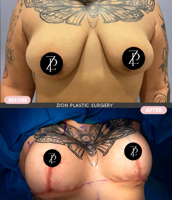 breast lift