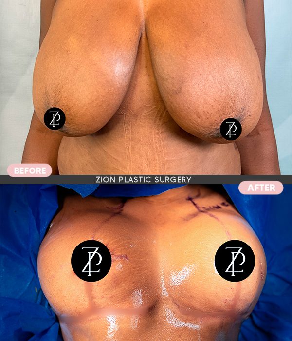 breast cosmetic