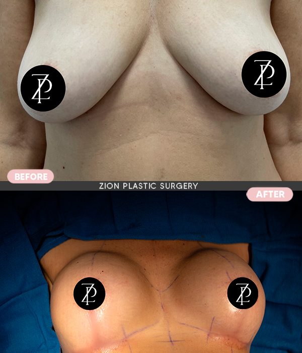 breast cosmetic