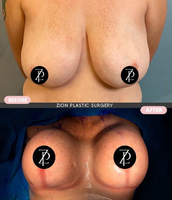 breast cosmetic