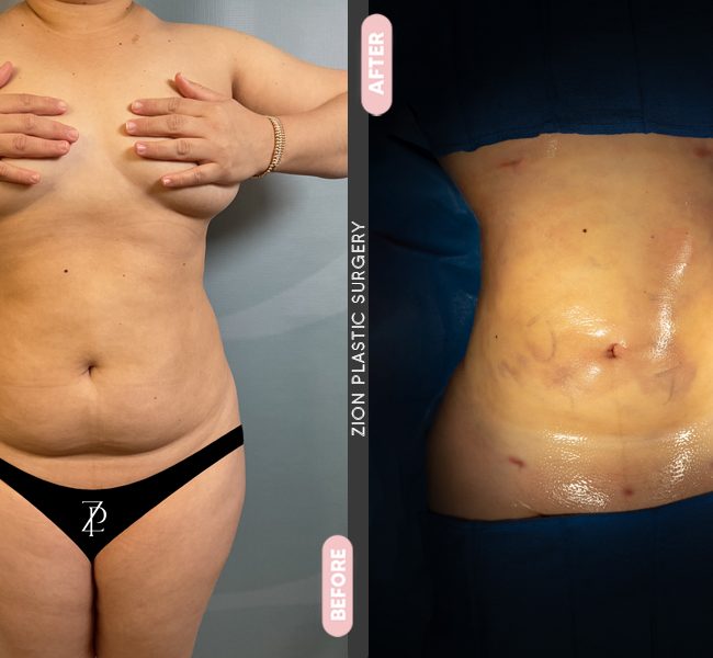 Tummy Tuck in Zion Plastic