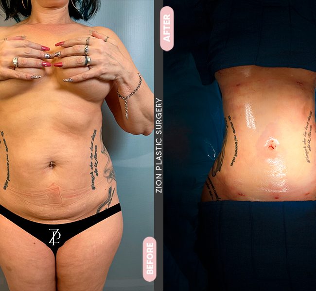 Tummy Tuck in Zion Plastic