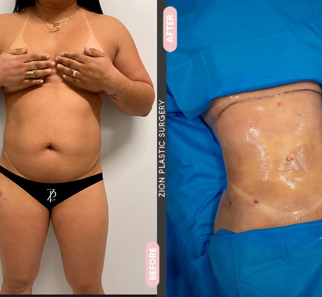 Tummy Tuck in Zion Plastic