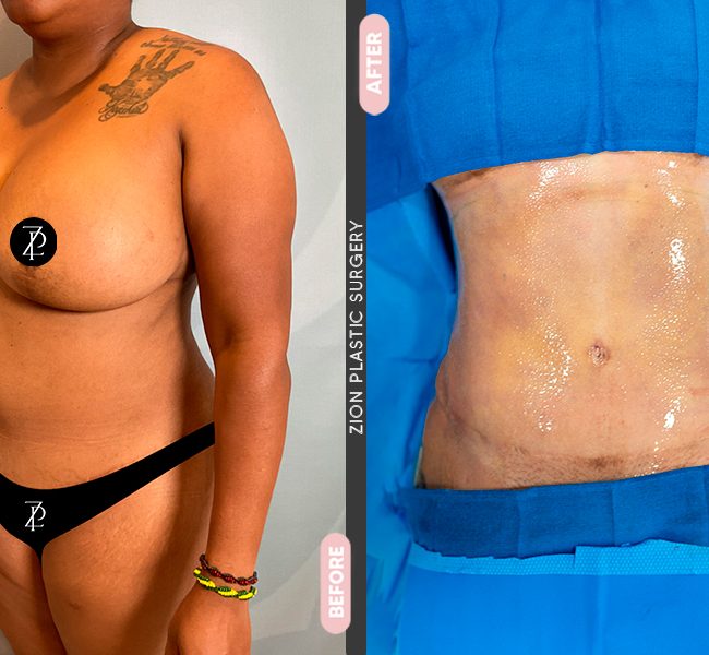 Tummy Tuck in Zion Plastic