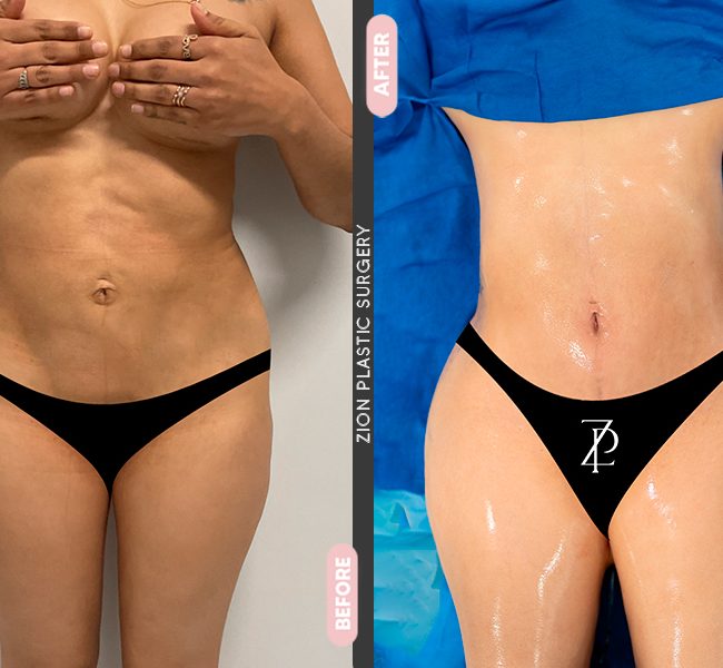 Tummy Tuck in Zion Plastic