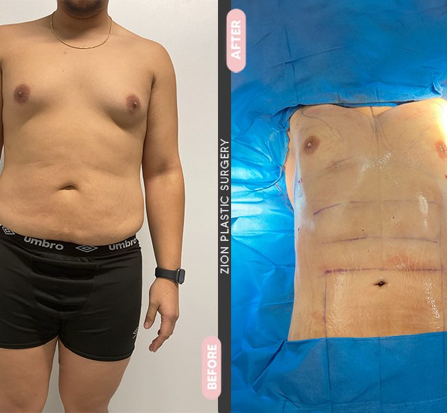 Tummy Tuck in Zion Plastic