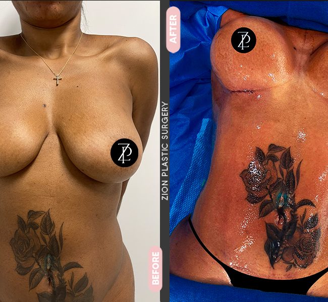 mommy body makeover in Zion Plastic Surgery