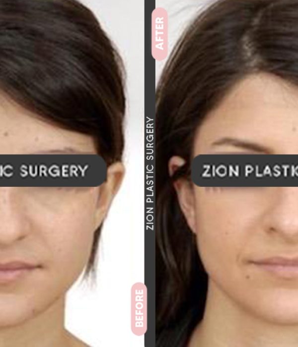 Rhinoplasty