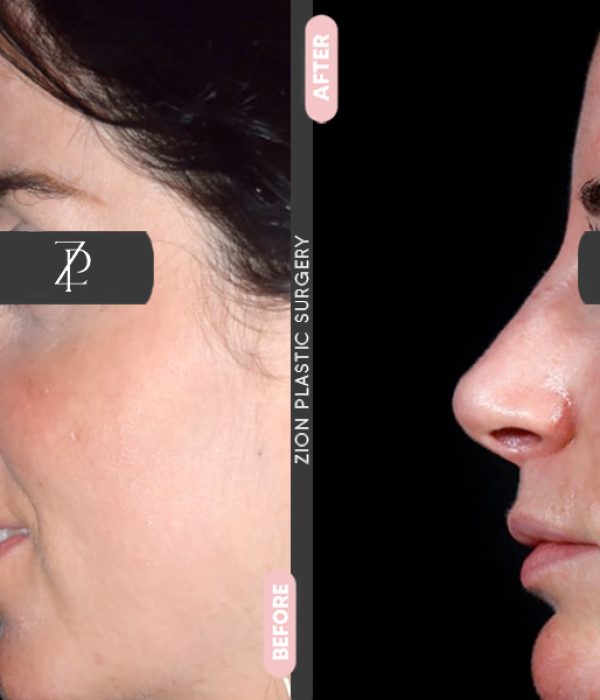 Rhinoplasty