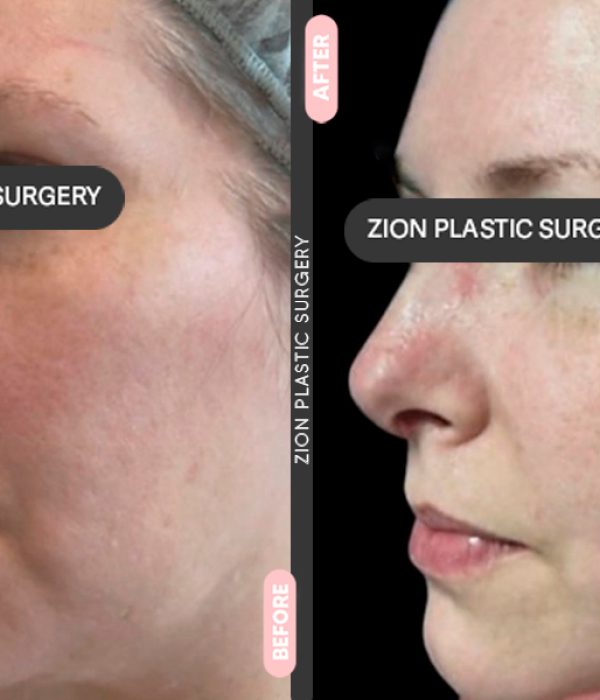 Rhinoplasty Zion