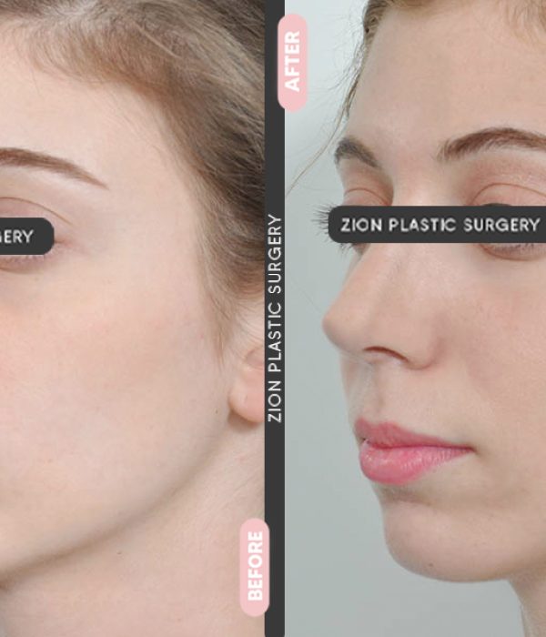 Rhinoplasty