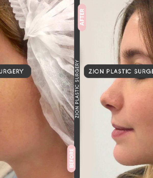 Rhinoplasty