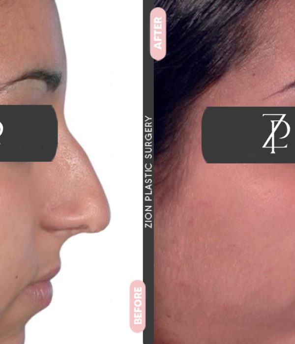 Rhinoplasty