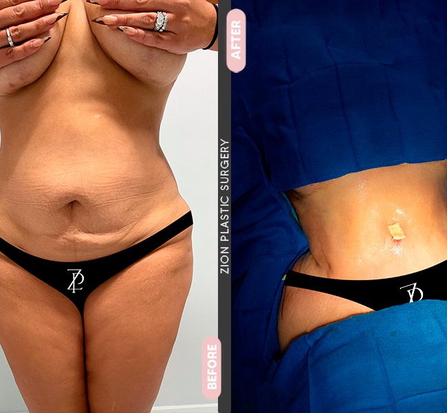 Liposuction surgery