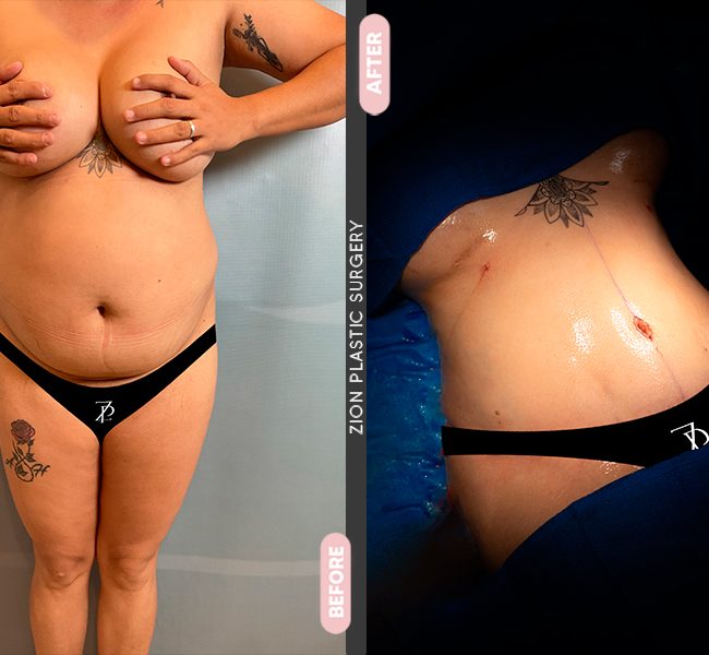 Tummy Tuck in Zion Plastic