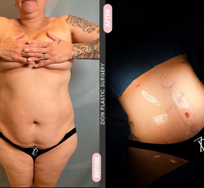 Tummy Tuck in Zion